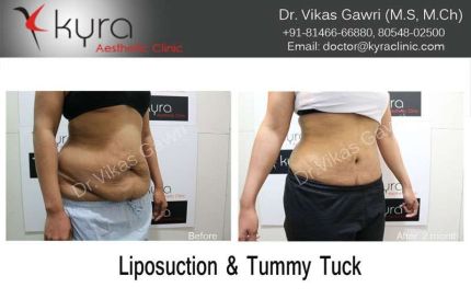 Liposuction Tummy Tuck