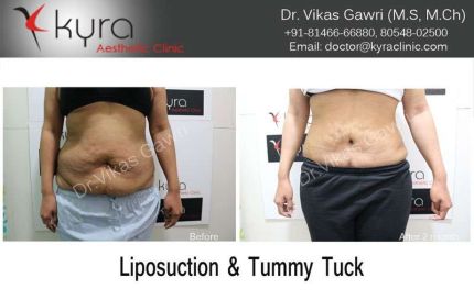 Liposuction Tummy Tuck