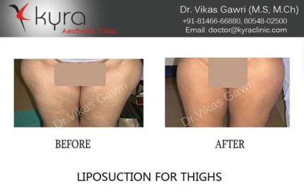 Liposuction for thighs