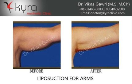 Liposuction of Arms