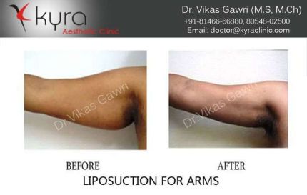 Liposuction of Arms