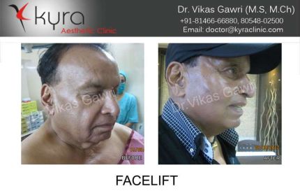 Male Facelift surgery in Ludhiana View results