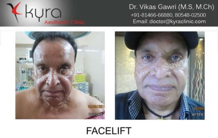 Male Facelift surgery in Ludhiana