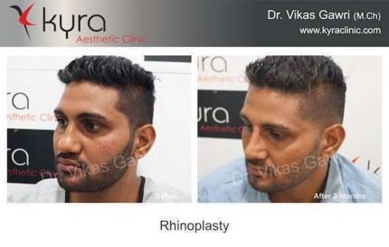 Nose Surgery in Ludhiana View results