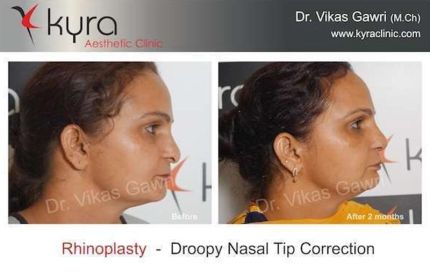 Nose Surgery in Ludhiana