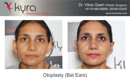 Otoplasty Bat Ears