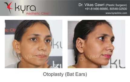 Otoplasty Bat Ears