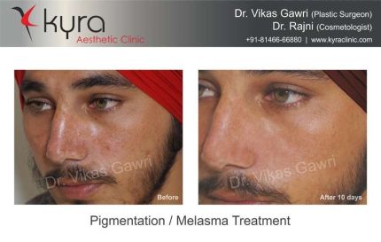 Pigmentation Melasma Treatment 