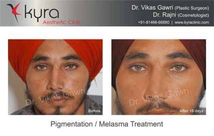 Pigmentation Melasma Treatment