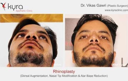 Rhinoplasty Dorsal Augmentation Nasal Tip Modification Alar Base Reduction