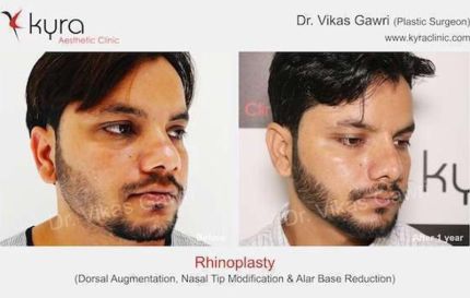 Rhinoplasty Dorsal Augmentation Nasal Tip Modification Alar Base Reduction