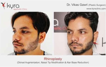 Rhinoplasty Dorsal Augmentation Nasal Tip Modification Alar Base Reduction