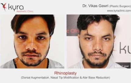 Rhinoplasty Dorsal Augmentation Nasal Tip Modification Alar Base Reduction