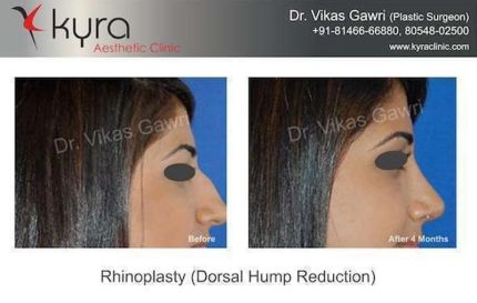 Rhinoplasty-Dorsal-Hump-Reduction