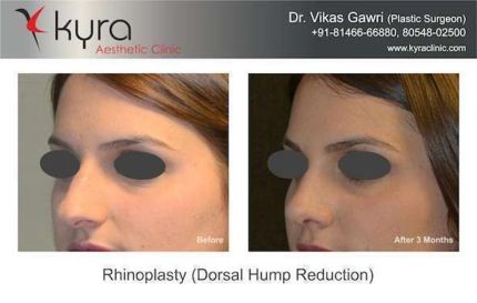 Rhinoplasty Dorsal Hump Reduction