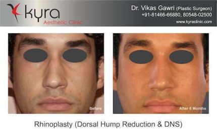 Rhinoplasty Dorsal hump Reduction And DNS