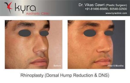 Rhinoplasty Dorsal hump Reduction DNS