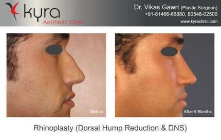 Rhinoplasty Dorsal hump Reduction