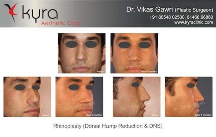 Rhinoplasty Dorsal hump Reduction