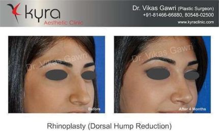 Rhinoplasty Dorsal hump Reduction