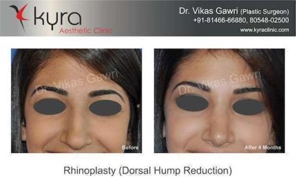 Rhinoplasty Dorsal hump Reduction