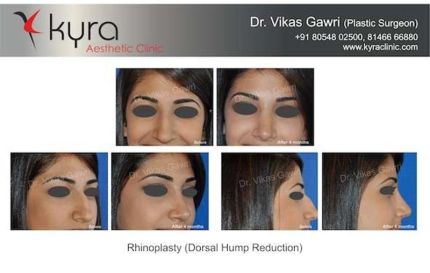 Rhinoplasty Dorsal hump Reduction