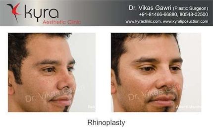 Rhinoplasty Dorsal hump Reduction