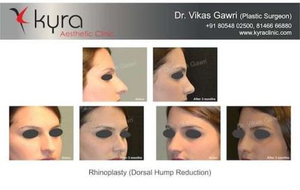 Rhinoplasty Dorsal hump Reduction