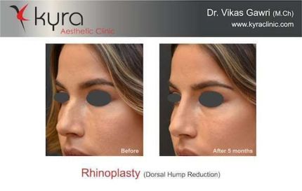 Rhinoplasty Dorsal hump Reduction