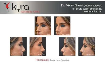 Rhinoplasty Dorsal hump Reduction