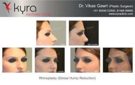 Rhinoplasty Dorsal hump Reduction