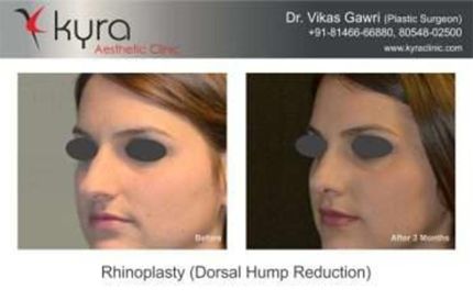 Rhinoplasty Dorsal hump Reduction