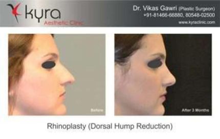 Rhinoplasty Dorsal hump Reduction