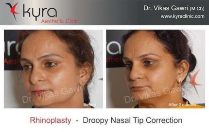 Rhinoplasty Droopy Nasala Tip Correction