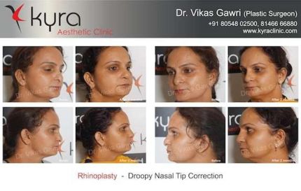 Rhinoplasty Droopy Nsala Tip Correction