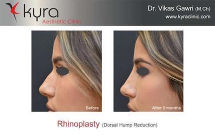 Rhinoplasty Droopy Nsala Tip Correction