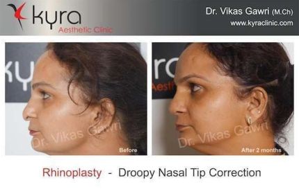 Rhinoplasty For Droopy Nasal Tip Correction