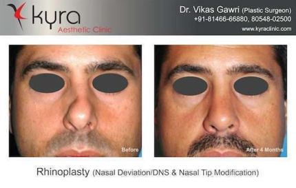 Rhinoplasty Nasal Deviation DNS Nasal Tip Modification