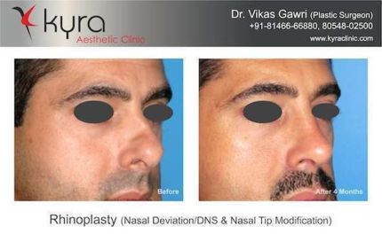 Rhinoplasty Nasal Deviation DNS Nasal Tip Modification