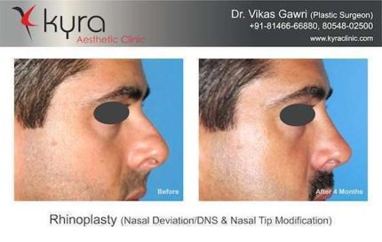 Rhinoplasty Nasal Deviation DNS Nasal Tip Modification