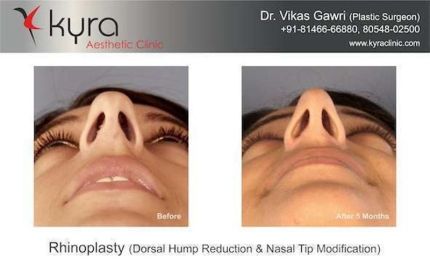 Rhinoplasty Nasal Deviation DNS Nasal Tip Modification