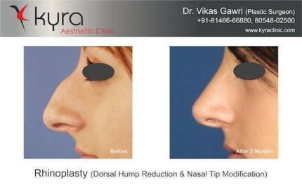 Rhinoplasty Nasal Deviation DNS Nasal Tip Modification