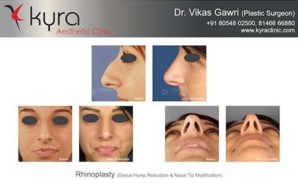 Rhinoplasty Nasal Deviation DNS Nasal Tip Modification