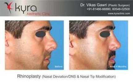 Rhinoplasty Nasal Deviation DNS Nasal Tip Modification