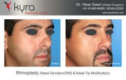 Rhinoplasty Nasal Deviation DNS Nasal Tip Modification