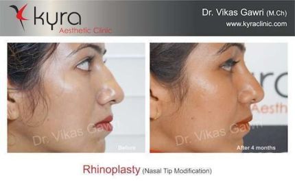 Rhinoplasty Nasal Tip Modification