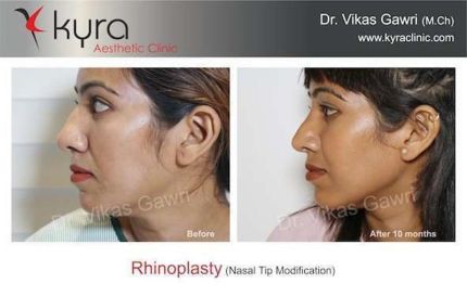 Rhinoplasty Nasal Tip Modification