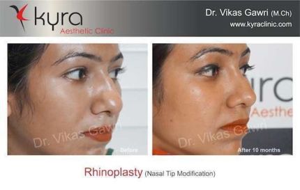 Rhinoplasty Nasal Tip Modification