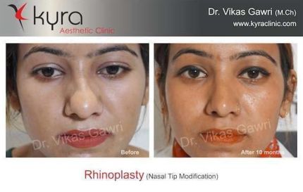 Rhinoplasty Nasal Tip Modification