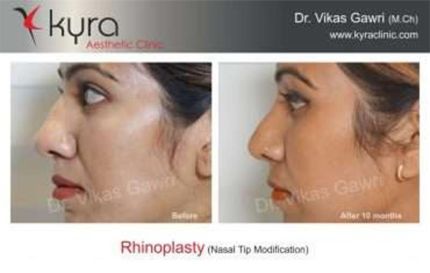 Rhinoplasty Nasal Tip Modification